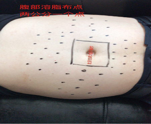 hospital Slimming Lipo Fat Burning Injections PPC For Fat Dissolving