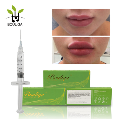 High Ha Concentration Long Lasting Hyaluronic Acid Dermal Injections For Face Contouring Lip Enhancement